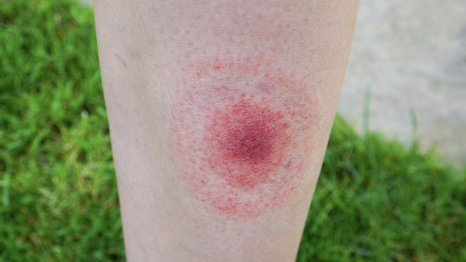 halsizlik ve kizariklik lyme hastaliginda sinsi tehlike tedavi edilmediginde kalici ve agir tablolara ilerleyebiliyor EiifaEym