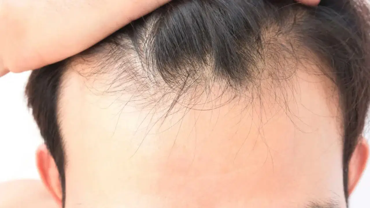 sac dokulmesinde gizli neden vitamin ve mineral eksikligi ne kadar etkili 6ItNWtOB.jpg